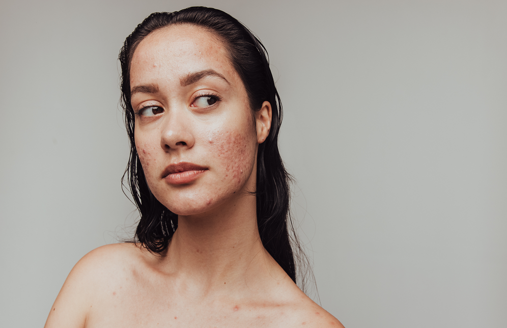 The Best Skincare for Acne